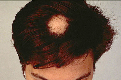 alopecia areata femeie barbat par scalp