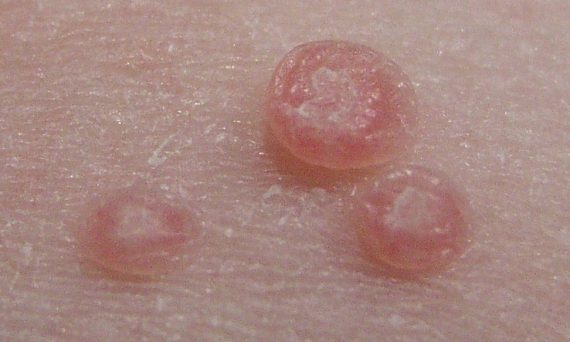 molluscum contagiosum copil piele roz papule ombilicate