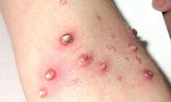 molluscum contagiosum virus piele tegument brat