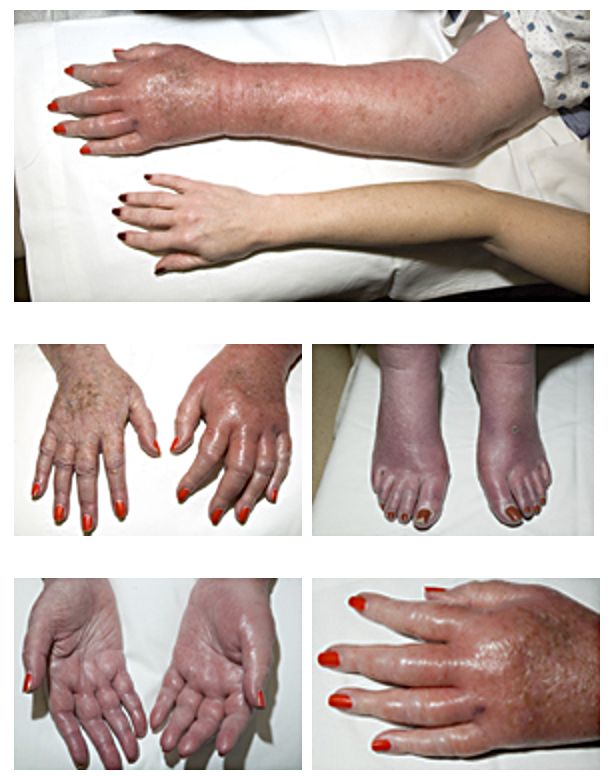 efectele gerului eritromelalgia brate maini picioare frig piele iarna