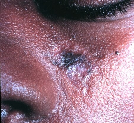 lupus eritematos discoid fata african afroamerican