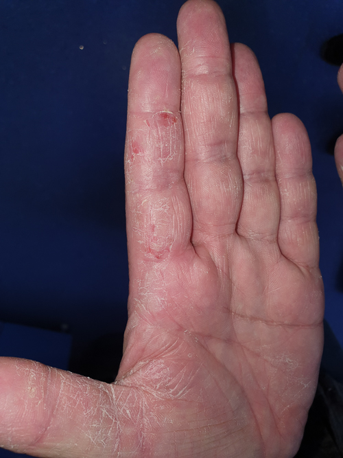 contact dermatită între degete