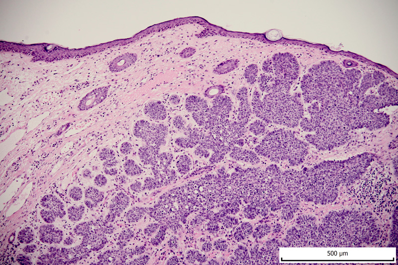 carcinom bazocelular histopatologie
