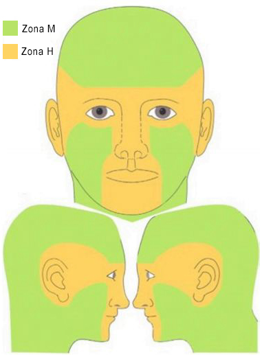 carcinom bazocelular zone de risc