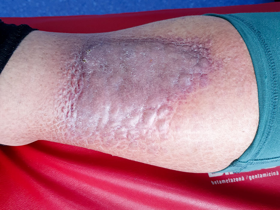 Ulcer pe jos decât tratați varicoza, Un ulcer pe picior decât pentru a trata vene varicoase