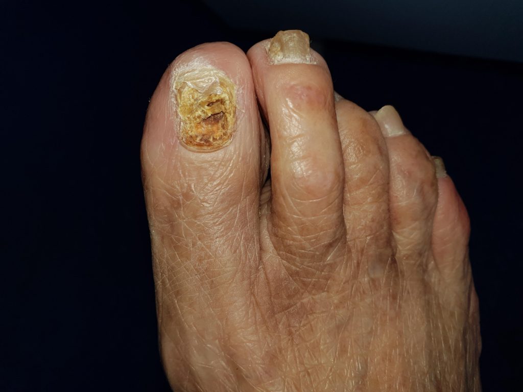 ciuperca groasă a unghiilor de la picioare)