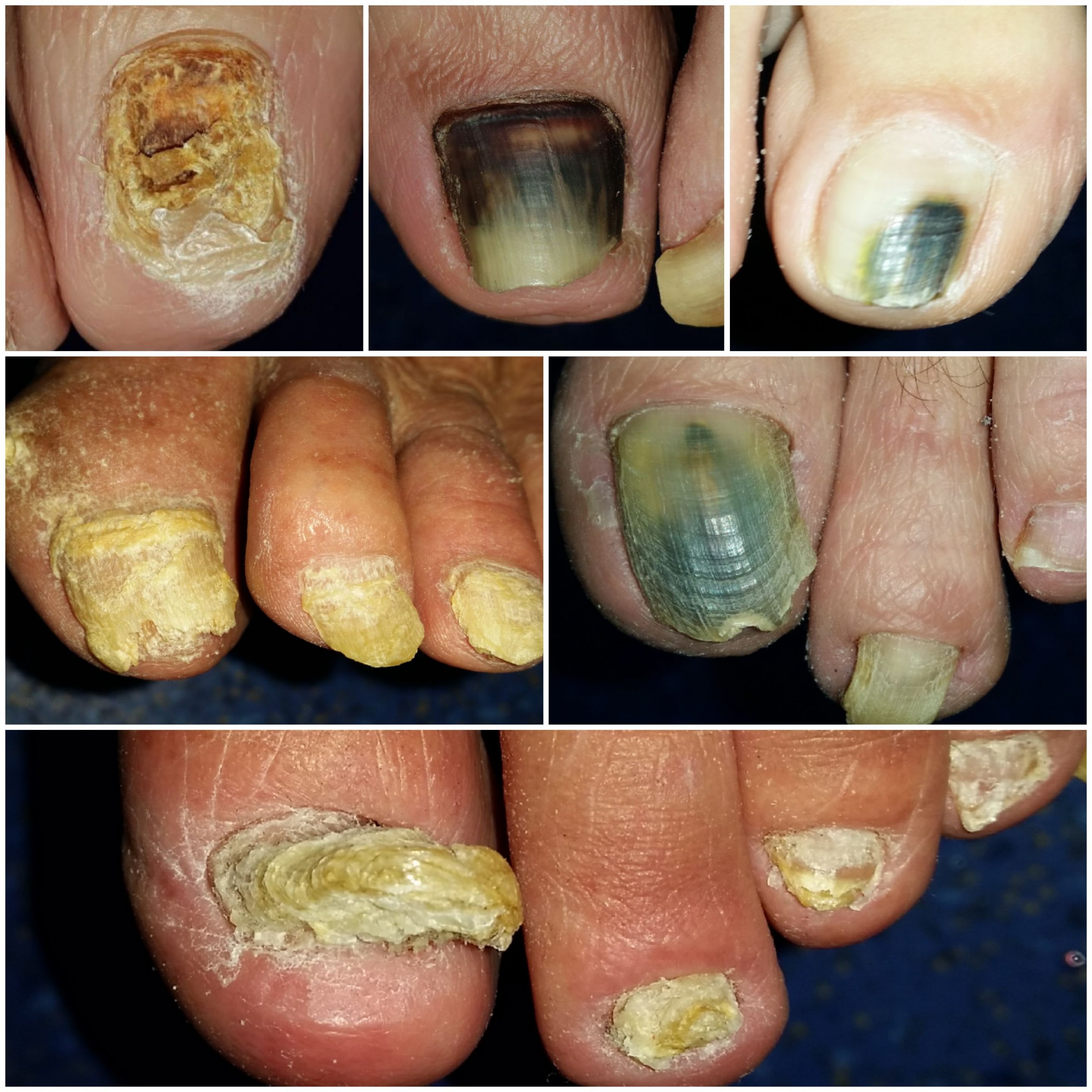 Ciuperca unghiei: simptome şi tratament