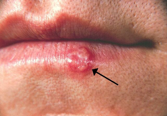 herpes simplex tip 1 hsv1